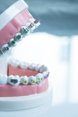 Obraz na płótnie Canvas Model denture with metal orthodontics