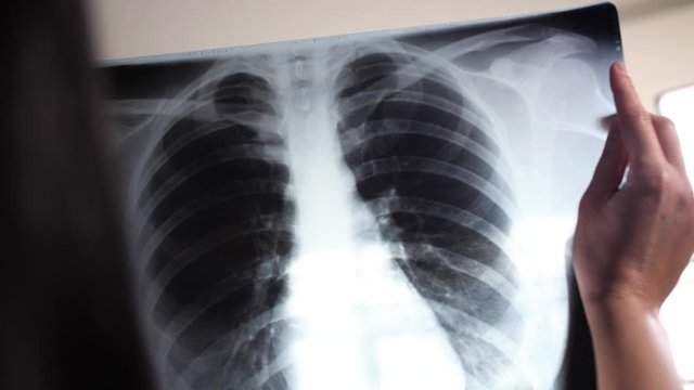 Close up.The doctor  looking at a lung x-ray image