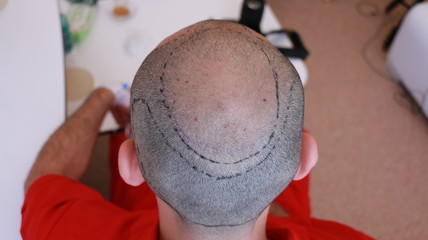 hair transplantation