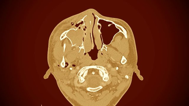 Computed tomography of the skull. Brain and orbit scan examination finding mass or tumor in side face.Blue tone process.