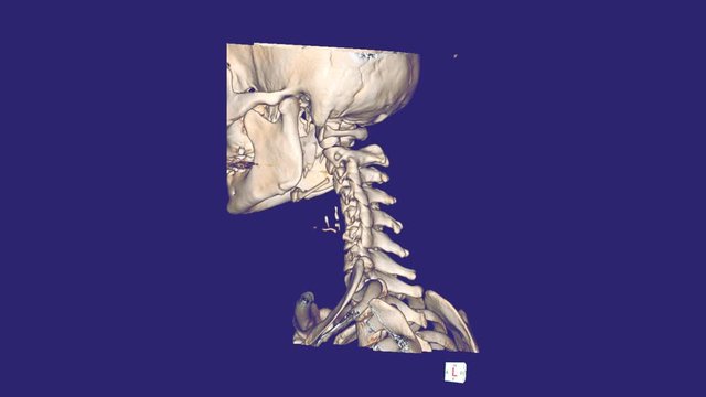 CT C-Spine or Cervical spine 3D Rendering image IMPRESSION :Reverse cervical lordosis Thoracic scoliosis with cervical spondylosis from C4-5 to C7-T1.
