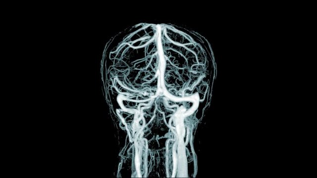 Magnetic Resonance Angiography(MRA)of the brain or cta brain 3D Rendering image white color rotating on the screen from mra scanner.