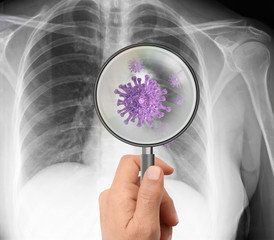 Magnifying glass showing covid-19 virus bacte - X-ray of human pneumonia lungs