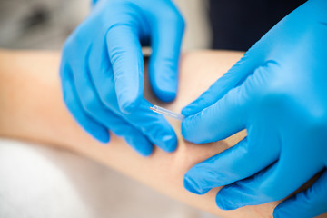 Hands of physiotherapist doing a dry needling