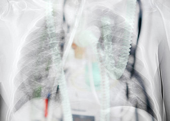 Double exposure of x-ray image of lung with pneumonia and ICU medical ventilator