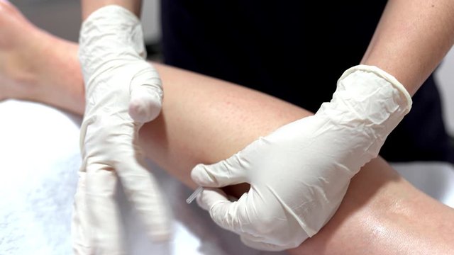 Hands of physiotherapist doing a dry needling