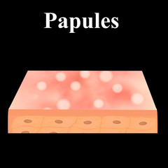 Papules. Acne on the skin. Dermatological and cosmetic diseases on the skin of the face acne. Infographics. Vector illustration on isolated background.