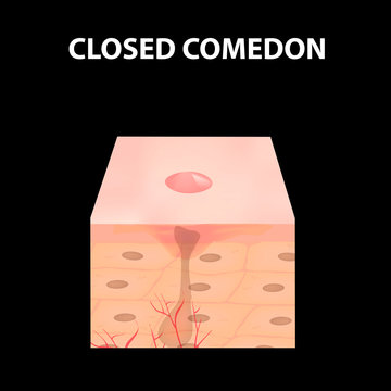 Closed comedones. Acne on the skin. Dermatological and cosmetic diseases on the skin of the face acne. Infographics. Vector illustration on isolated background.