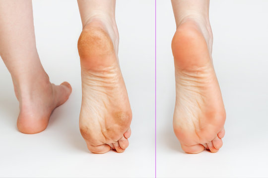 Female feet with corns and calluses and without them, on a white background. Foot close-up. Cosmetology and medicine. Before and after concept