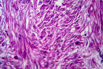 Uterine tumour, light micrograph