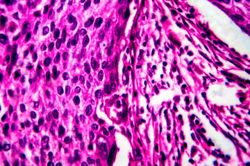 Squamous cell carcinoma of the uterus, light micrograph