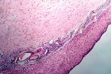 Ovarian cyst, light micrograph
