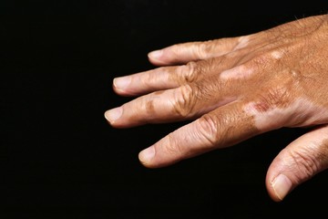 Hand with vitiligo on black background.