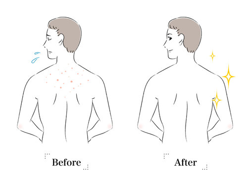 217 Best じんましん Images Stock Photos Vectors Adobe Stock