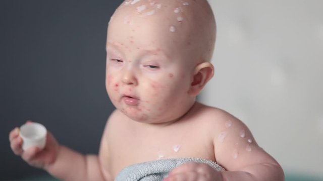 A little sad boy with chickenpox.The child has a lot of blisters and smallpox from chickenpox on the skin. Dad treats the baby.