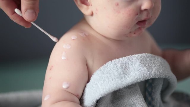 A little sad boy with chickenpox.The child has a lot of blisters and smallpox from chickenpox on the skin. Dad treats the baby.