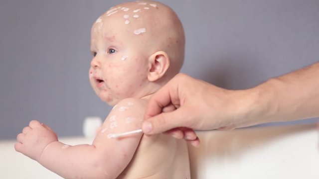 A little sad boy with chickenpox.The child has a lot of blisters and smallpox from chickenpox on the skin. Dad treats the baby.