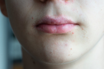 teenage boy with acné spots and dry lips.close up.