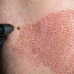 Fibroblast, plasmalifting procedure womens skin lifting