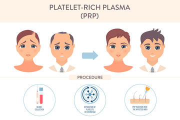 Hair loss treatment by PRP therapy. Stages of platelet-rich plasma restoration procedure for men and women. Health care and medical concept. Vector illustration.