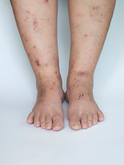 Skin lesion and Dark spot on the skin of a person's legs on a white background