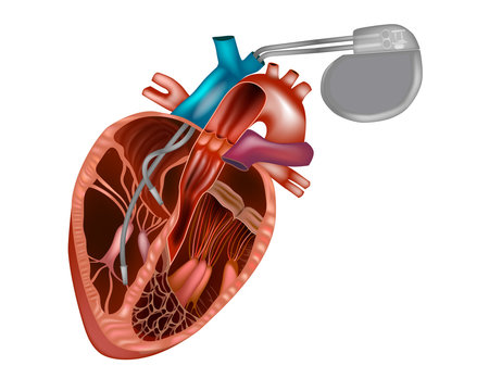 Cardiac pacemaker or artificial pacemaker. Heart pacemaker