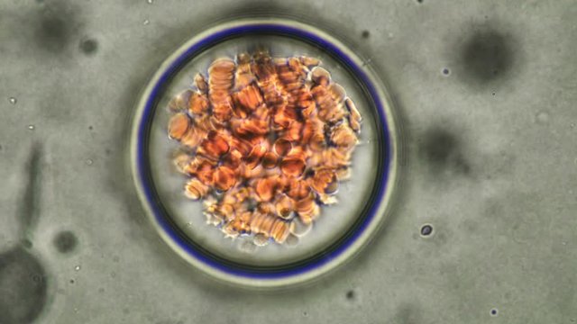 blood under a microscope, a clot of adhering red blood cells, some changed shape