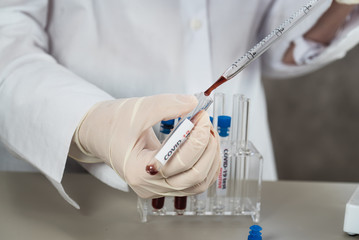 Positive COVID-19, SARS-COv2 test and laboratory sample of blood testing for diagnosis new Coronavirus infection..
