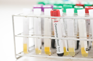 Blood test tube  for laboratory analysis.Laboratory testing patient’s blood samples.Conceptual image coronavirus (COVID-19) test tube sample that has tested positive for coronavirus.