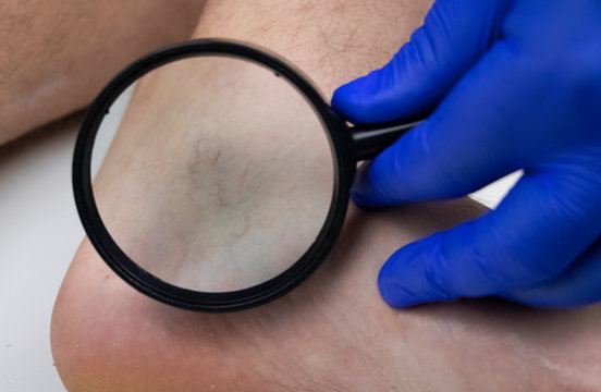 A man in consultation with a vascular surgeon. A doctor examines a leg with swollen veins. Varicose veins on the leg