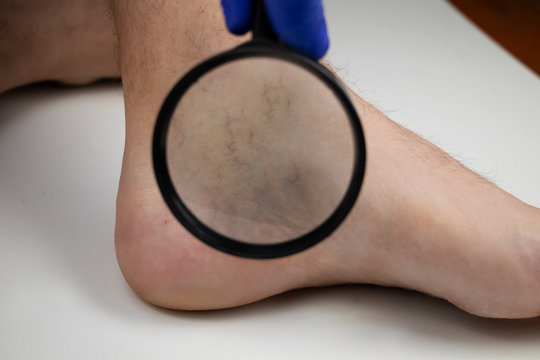 A man in consultation with a vascular surgeon. A doctor examines a leg with swollen veins. Varicose veins on the leg
