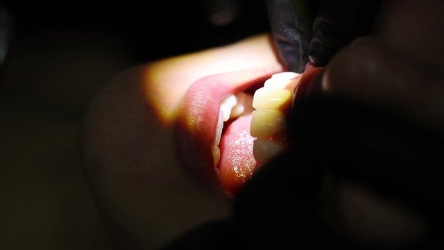 teeth workflow of the dentist veneer