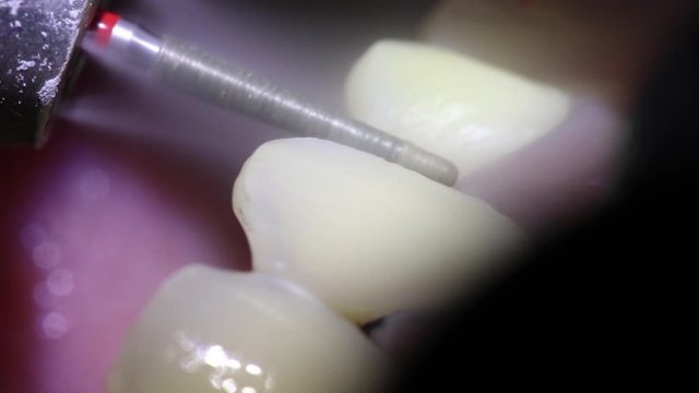 teeth workflow of the dentist veneer