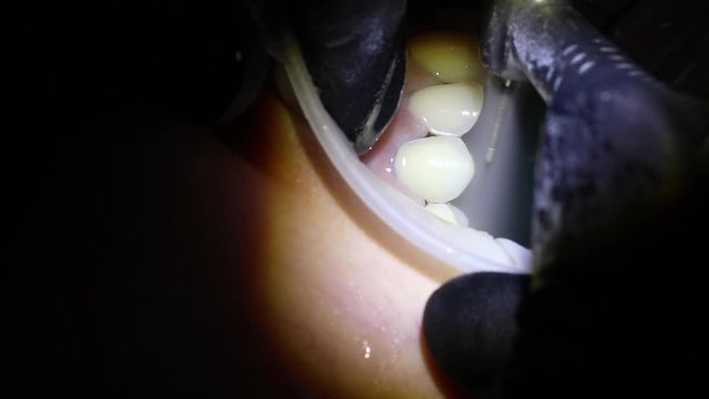 teeth workflow of the dentist veneer