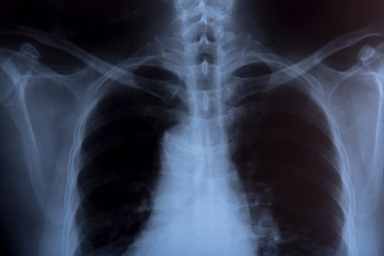 x-ray drawing of a human chest