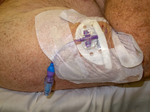 PICC line in arm of senior man in Cairns, Queensland, Austria