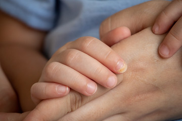 Hand-foot-mouth disease,the child has pinched a finger on a hand the nail hurts and peels off.