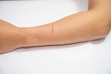 Close up old Men's arms hand, upper limb or arm to the wounded waiting and blood and lesion, slit...
