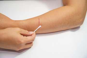 Close up Men's arms hand, upper limb or arm to the wounded blood and lesion, slit waiting for nurse treatment on clean the wound dressing a bloody, patient.