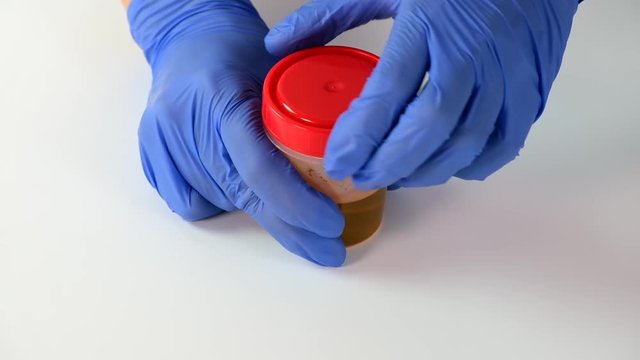 Doctor or laboratory technician opening container with urine sample for analysis and research in medical laboratory, medical urine test and health scanning.