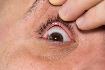 Eye injury, young man with burst blood vessel in eye, fatigue, problems with blood vessels