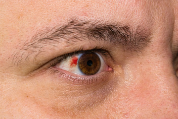 Eye injury, young man with burst blood vessel in eye, fatigue, problems with blood vessels