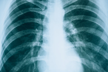X-ray: lungs. Fluorogram. Checking the lungs with a doctor.
