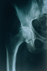 X-ray: hip joint. Joint injury, hip fracture concept
