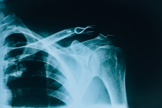 X-ray of the shoulder. Clavicle fracture.