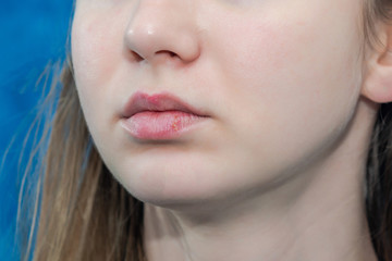 Fototapeta premium Close-up of female lips suffering from herpes. Lips virus infected herpes