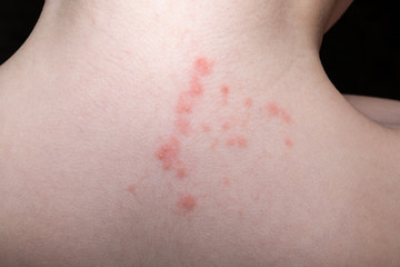 baby skin rash and allergy with red spot cause