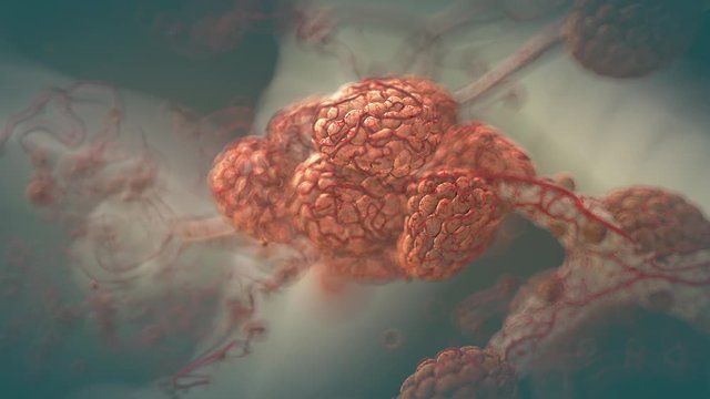 Realistic 3d animation of disease process COVID-19 bringing to viral pneumonia. Lungs infection caused by virus. Lung cells alveoli infected by coronavirus SARS-CoV-2