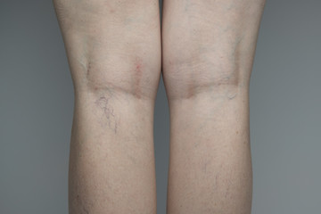 Close up of a woman standing facing a gray background exposing the back of her legs with pale skin, freckles, and spider veins 