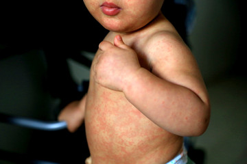 Child with measles symptoms